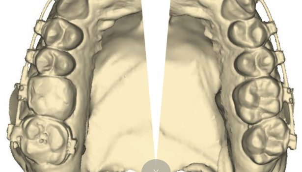 OWP_4_19_ZMIANY_PO_ZABIEGU_POSZERZENIA_SZCZEKI_RYC_3_A