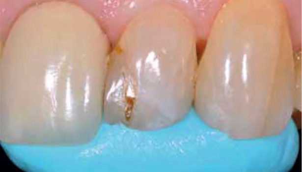 Odbudowa bezpośrednia