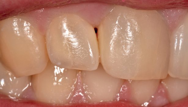 Przebarwienia zębów przednich