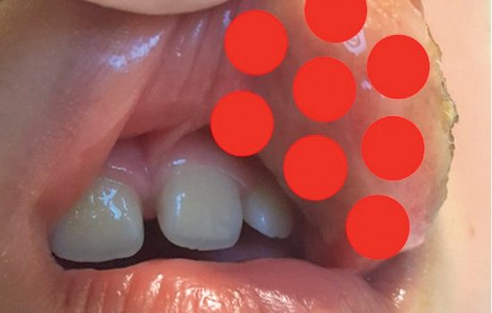 Zastosowanie lasera diodowego