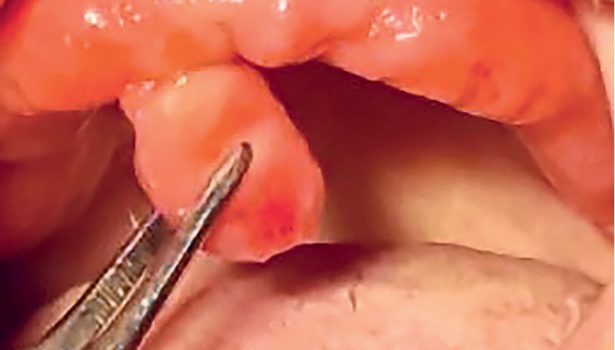 Korekta podłoża protetycznego