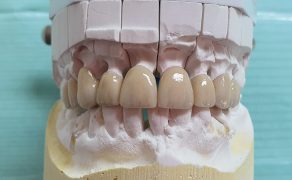 Korekta wychylenia zębów