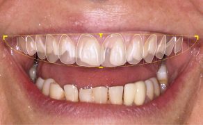 leczenie zespołowe ortodontyczno-protetyczne