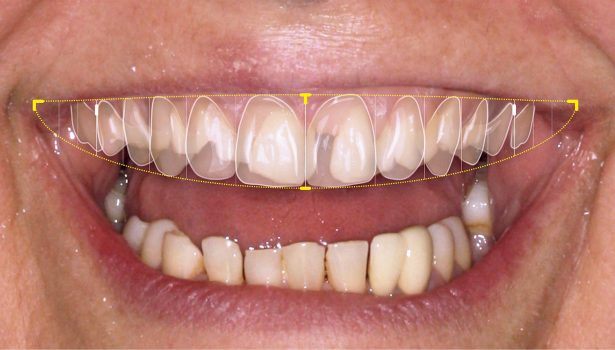 leczenie zespołowe ortodontyczno-protetyczne