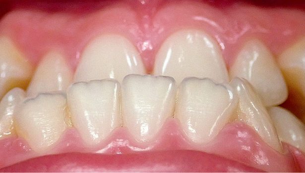 Leczenie zespołowe przodożuchwia