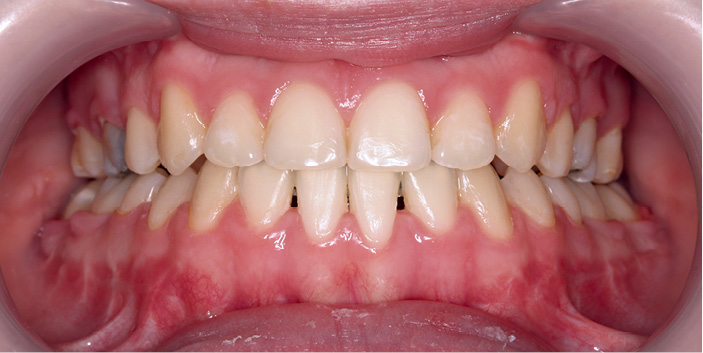 TPS_5_22_Magdalena_Soczka-Bojda_Adam_Bojda_LECZENIE_PRZODOZUCHWIA_FOT_81