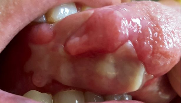 Fotobiomodulacja laserowa