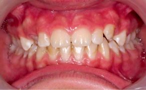 leczenie ortodontyczno-protetyczne