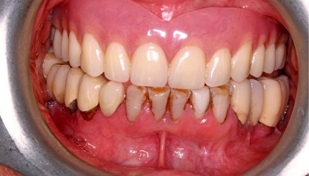 Proteza natychmiastowa