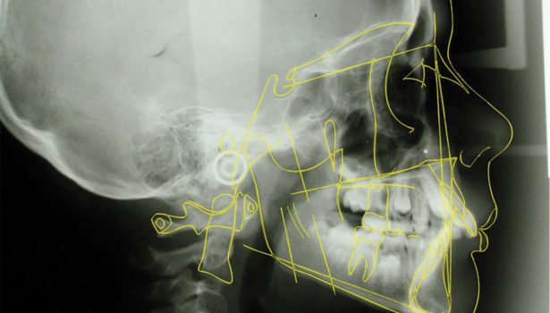 wady zgryzu klasy II