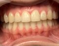 laserowe wybielanie zębów