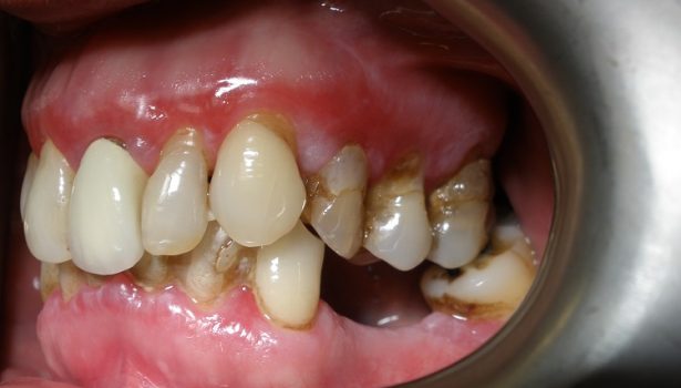 złuszczające zapalenie dziąseł