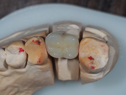 odbudowa protetyczna