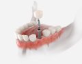 metale w stomatologii cyfrowej; Dental crown, abutment and implant. 3D illustration of human teeth and dentures on white background.