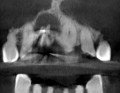 Nowoczesne koncepcje mikrochirurgii endodontycznej