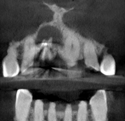 Nowoczesne koncepcje mikrochirurgii endodontycznej