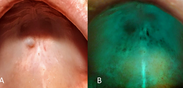 Zastosowanie lasera Er:YAG