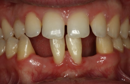 Leczenie implantoprotetyczne