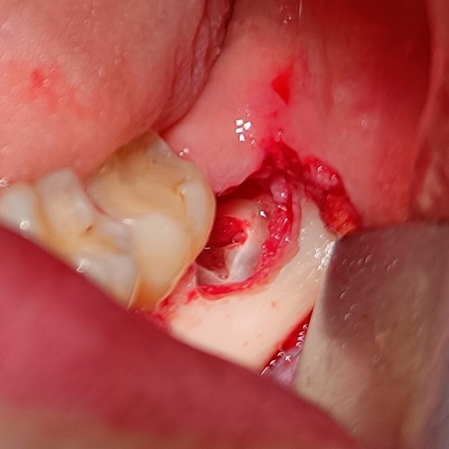 koronektomia