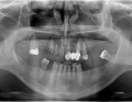 Fot. 1. Pantomogram pacjenta w dniu zgłoszenia się do gabinetu; fot. archiwum autorki