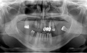 Fot. 1. Pantomogram pacjenta w dniu zgłoszenia się do gabinetu; fot. archiwum autorki