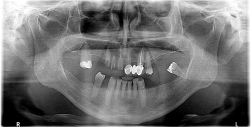 Fot. 1. Pantomogram pacjenta w dniu zgłoszenia się do gabinetu; fot. archiwum autorki