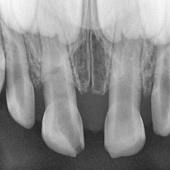 Uraz przyśrodkowych siekaczy; fot. archiwum autorki
