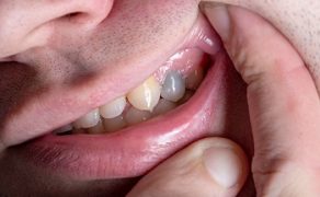 wybielanie zębów martywch; fot. iStock