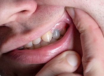 wybielanie zębów martywch; fot. iStock