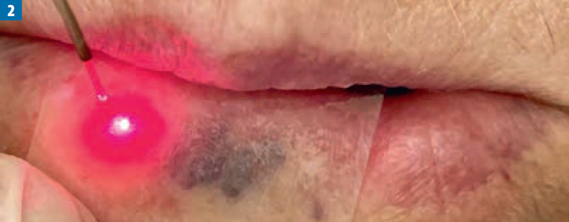 Zastosowanie wielofalowego lasera