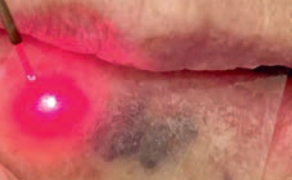 Zastosowanie wielofalowego lasera diodowego do usunięcia malformacji naczyniowej – opis przypadku