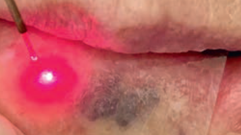 Zastosowanie wielofalowego lasera diodowego do usunięcia malformacji naczyniowej – opis przypadku