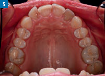 zastosowanie nakładek