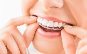 Dystalizacja zębów nakładkami ; fot. iStock