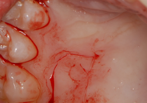 Zastosowanie lasera diodowego 635