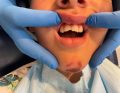 złamanie szkliwno-zębinowe