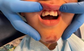 złamanie szkliwno-zębinowe