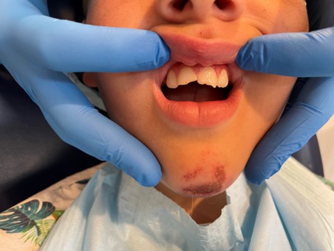 złamanie szkliwno-zębinowe