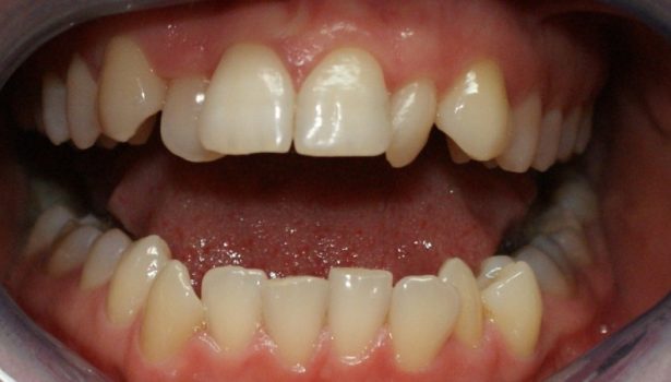 Clear Aligner; fot. archiwum autora