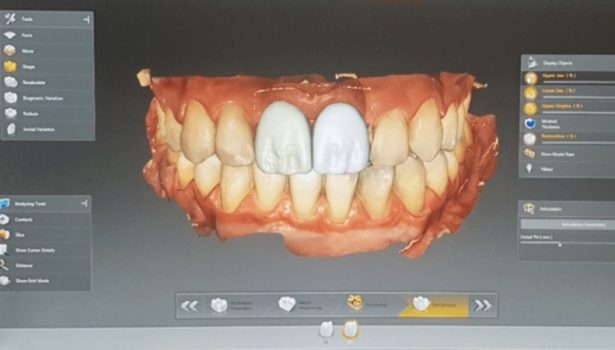 Wysoce estetyczna odbudowa implantoprotetyczna; fot. archiwum autorów