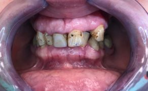 rekonstrukcja utraconych zębów