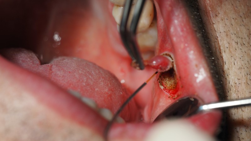 mucocele; fot. archiwum autorów