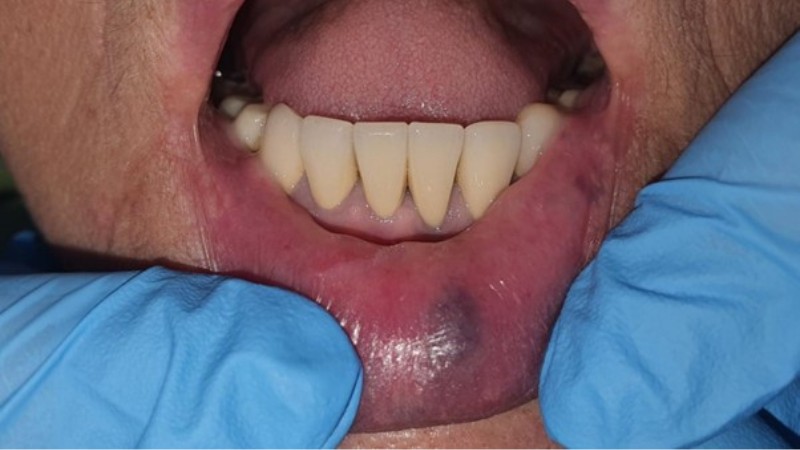 leczenie malformacji naczyniowych