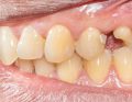 odbudowa zębów bocznych; fot. iStock