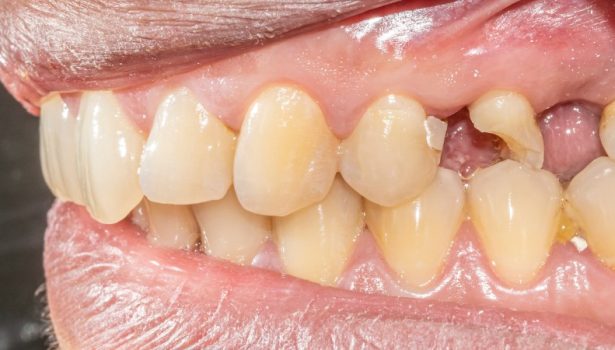 odbudowa zębów bocznych; fot. iStock