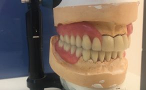 odbudowa braków zębowych