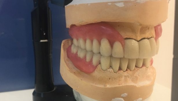 odbudowa braków zębowych
