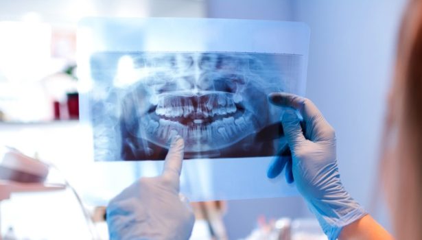 zdjęcie pantomograficzne; fot. iStock