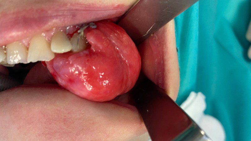 obwodowy włókniak kostniejący