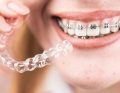 Kluczowe aspekty dystalizacji zębów; fot. iStock